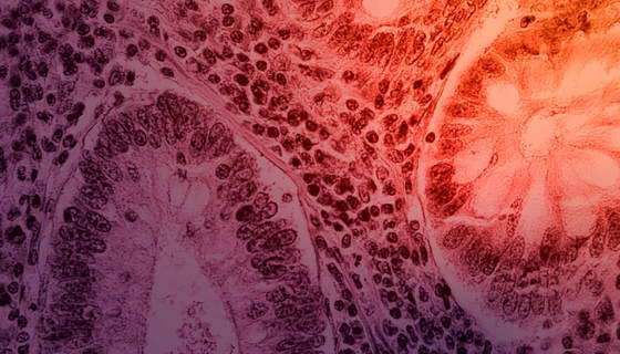 Transforming Early-Stage Colon Cancer Outcomes: Why We Invested in Solstice Oncology
